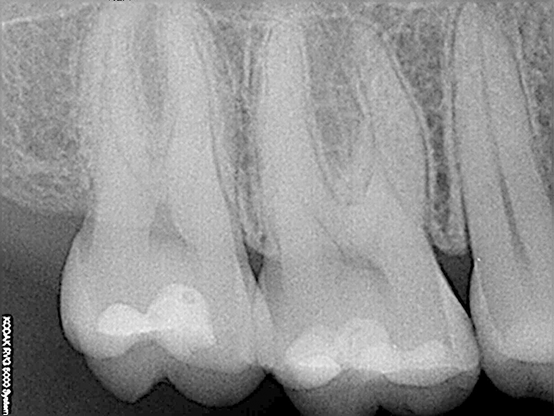 endo-antes