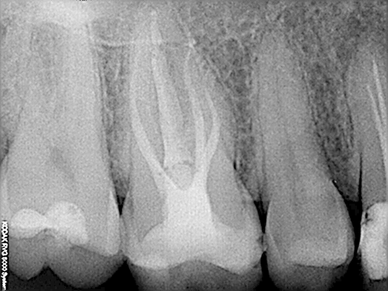 endo-despues