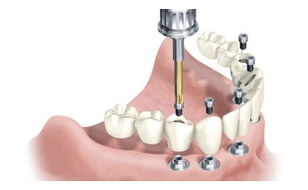 Protesis dental fija