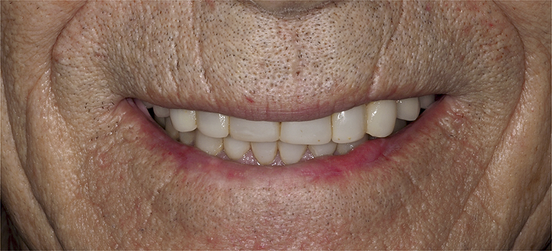 implantes-despues implantes-despues