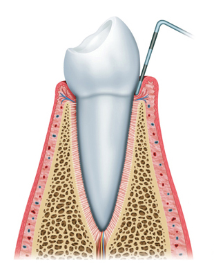 preiimplantitis (1) preiimplantitis (1)