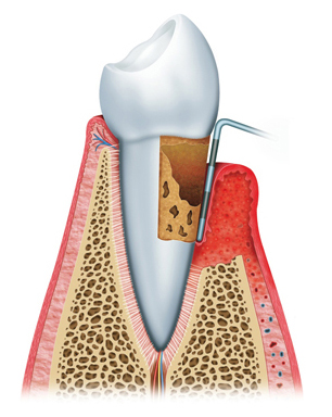 preiimplantitis (4) preiimplantitis (4)
