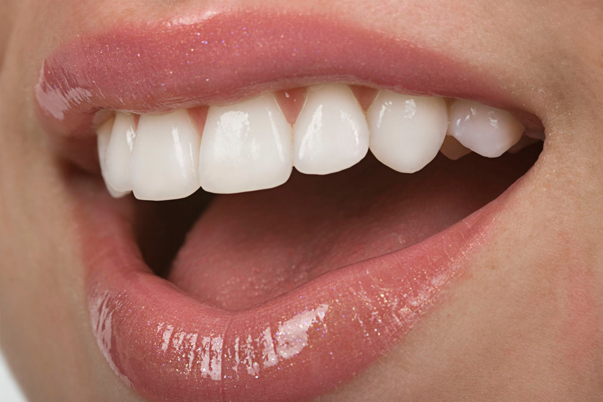 Estética Dental en Santa Cruz de Tenerife