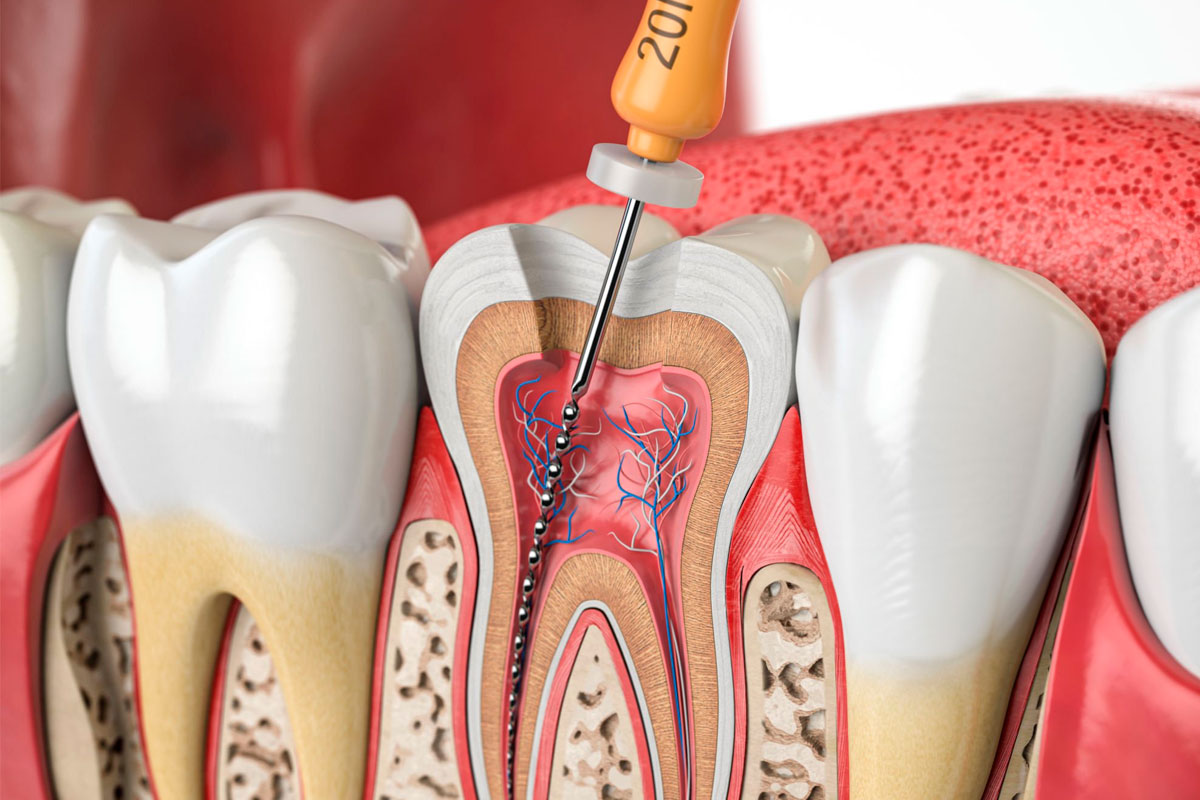 Endodoncia en Santa Cruz de Tenerife