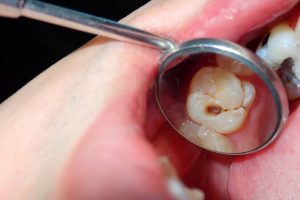 caries dentales tratamientos