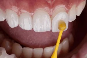 carillas dentales