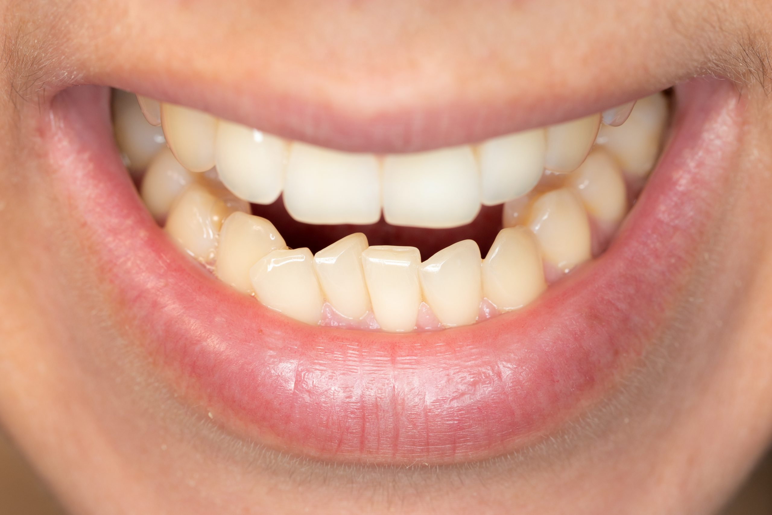 Apiñamiento dental