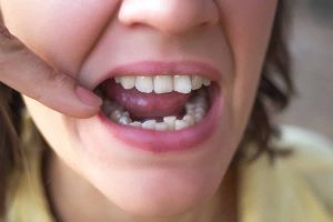 apiñamiento dental