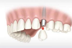 implantes dentales de carga inmediata