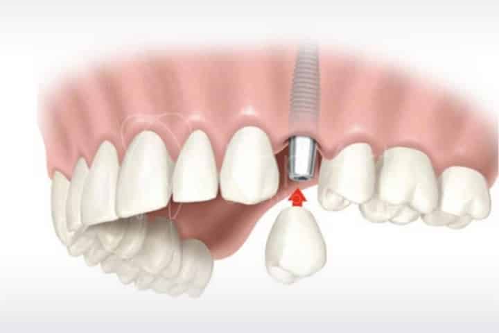 implantes dentales de carga inmediata